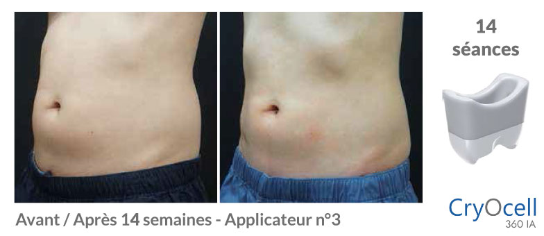 avant après cryolipolyse abdomen homme en 3 mois et demi