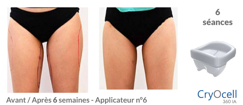 avant après cryolipolyse cuisse en 6 semaines