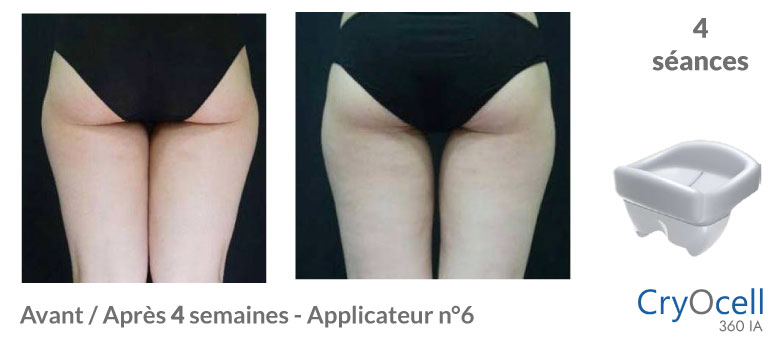 avant après cryolipolyse cuisse en 1 mois