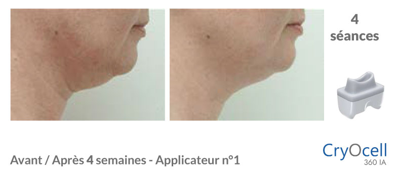 avant après cryolipolyse double menton en 4 semaines
