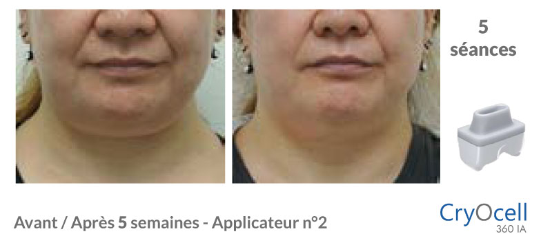 avant après cryolipolyse double menton en 5 séances