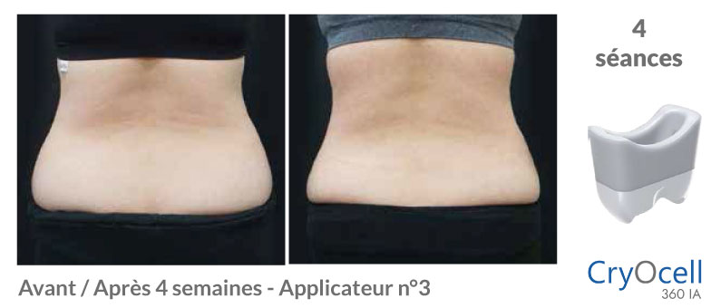avant après cryolipolyse dos en 1 mois de traitement