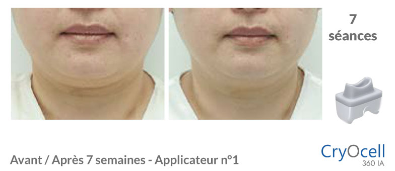avant après cryolipolyse menton en 7 séances