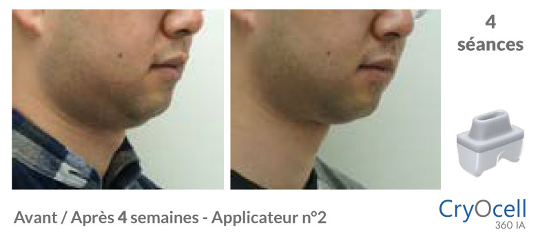 avant après cryolipolyse double menton en 4 semaines