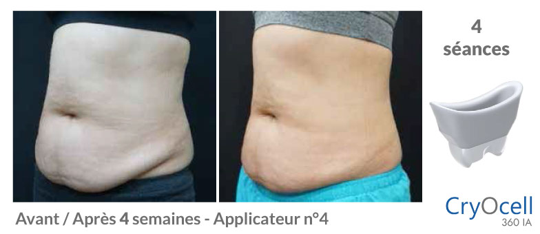 avant après cryolipolyse abdomen en 1 mois