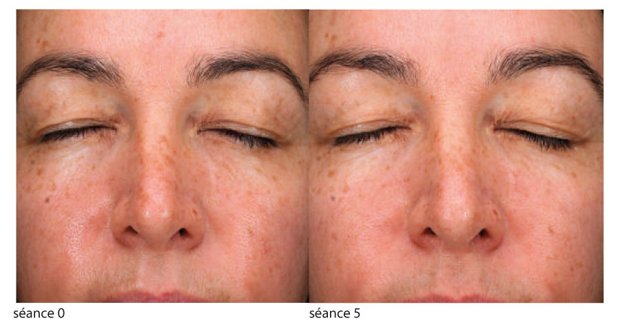 avant après peeling dépigmentant taches superficielles