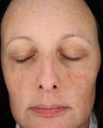 visage présentant des éphélides