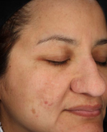 visage présentant des lentigos