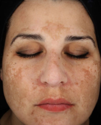 visage présentant un melasma