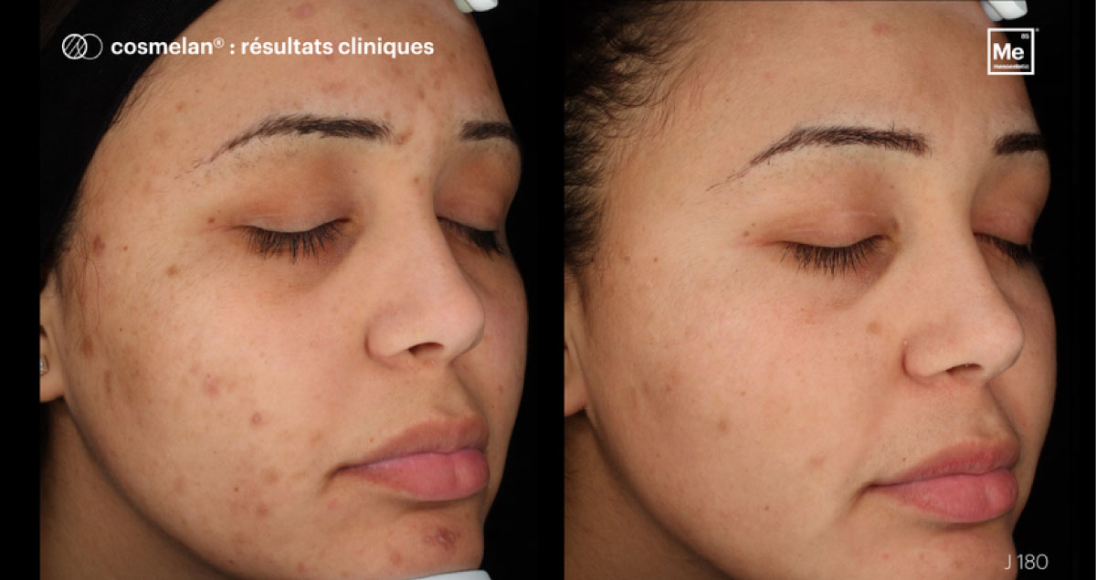 avant après soin anti tache hyperpigmentation cosmelan