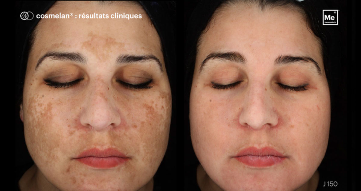avant après traitement melasma en institut avec cosmelan