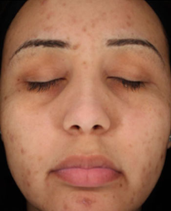 visage présentant une hyperpigmentation post inflammatoire