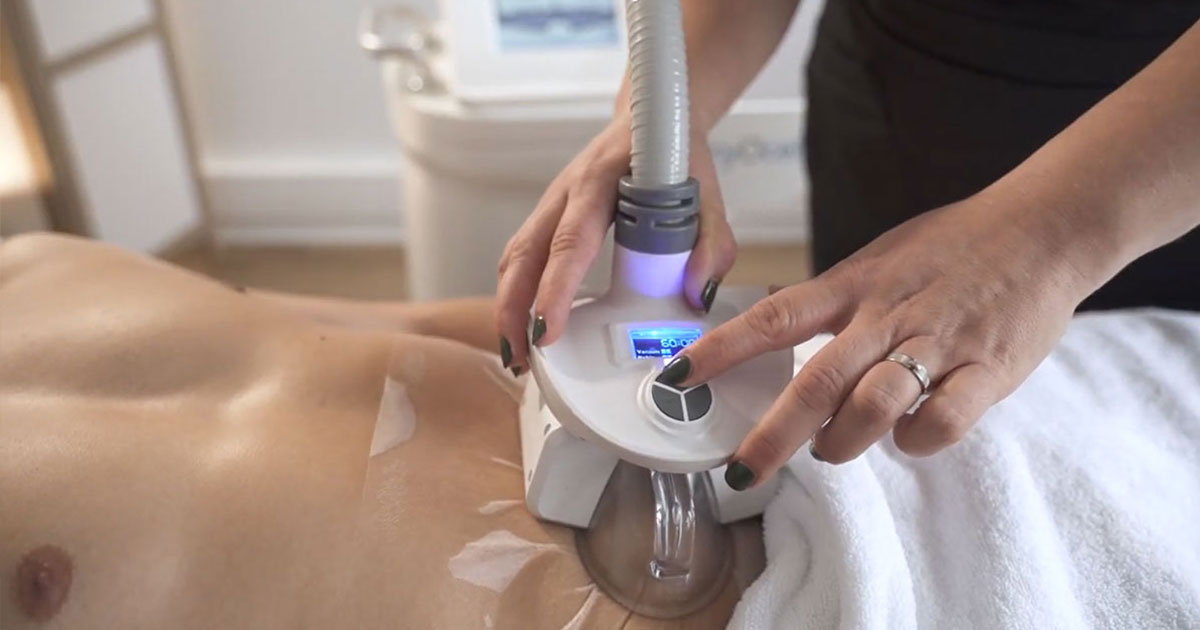 installation de la poignée d'aspiration et refroidissement pour la cryolipolyse de l'abdomen