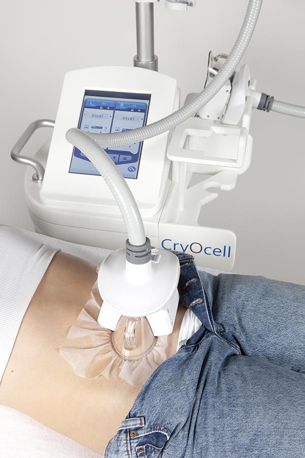 cryolipolyse par aspiration