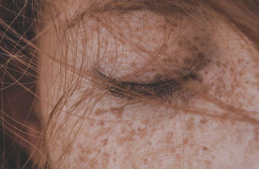 photographie d'un visage à la peau claire avec des taches pigmentaires