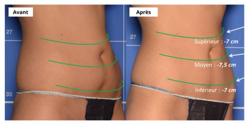 avant après radiofréquence ventre
