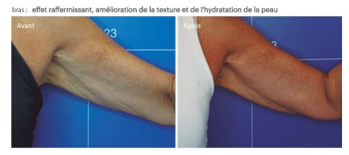 avant après peau des bras