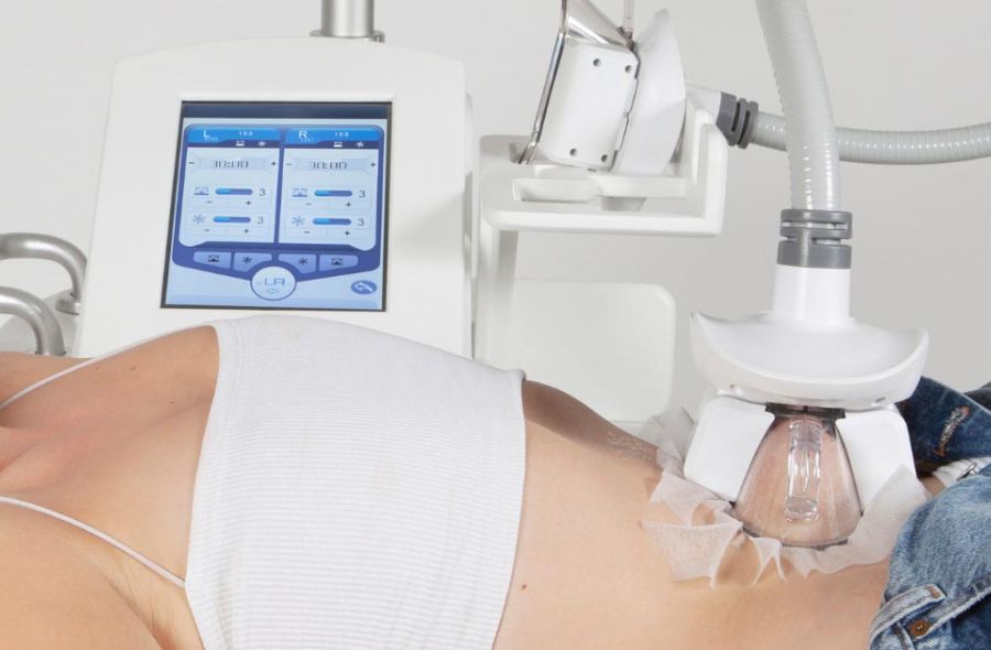 cryolipolyse de la graisse du ventre avec une poignée d'aspiration et de refroidissement