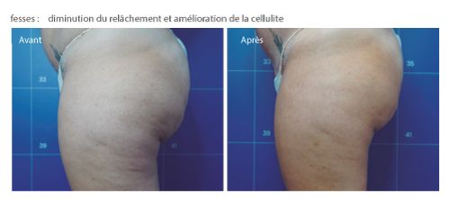 avant après radiofréquence cellulite fesse