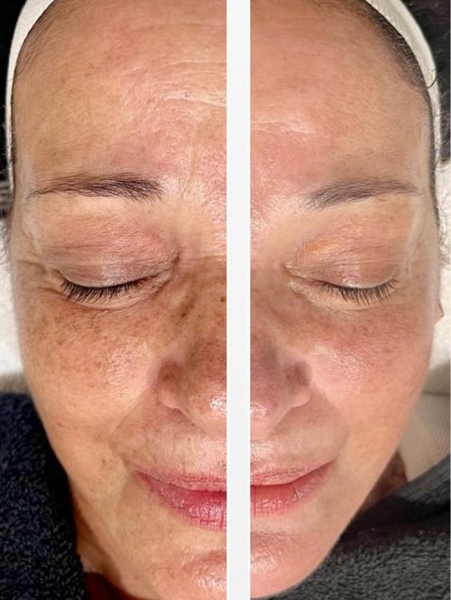 photo avant après skinretin xpert pack traitement anti-âge rétinol