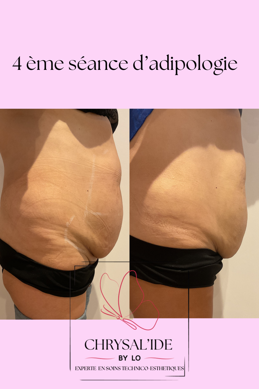 avant après : traitement minceur ventre avec Adipologie®