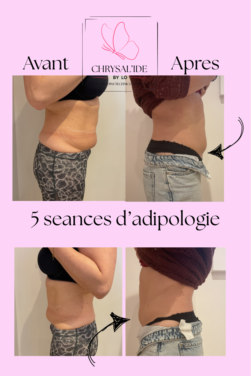 avant après : traitement minceur ventre avec Adipologie® (résultats après 5 séances)