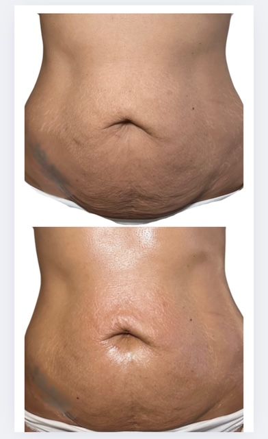 avant après bodyshock® + LED