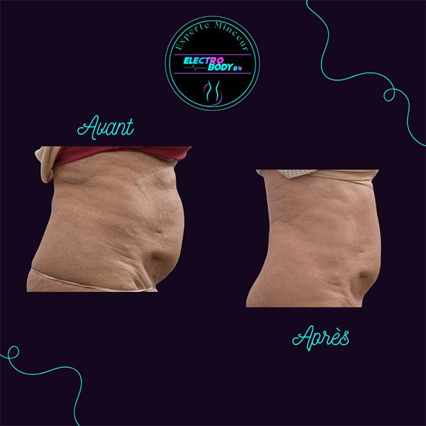 avant/après : résultats d'un soin minceur avec Electrobody (Thor)
