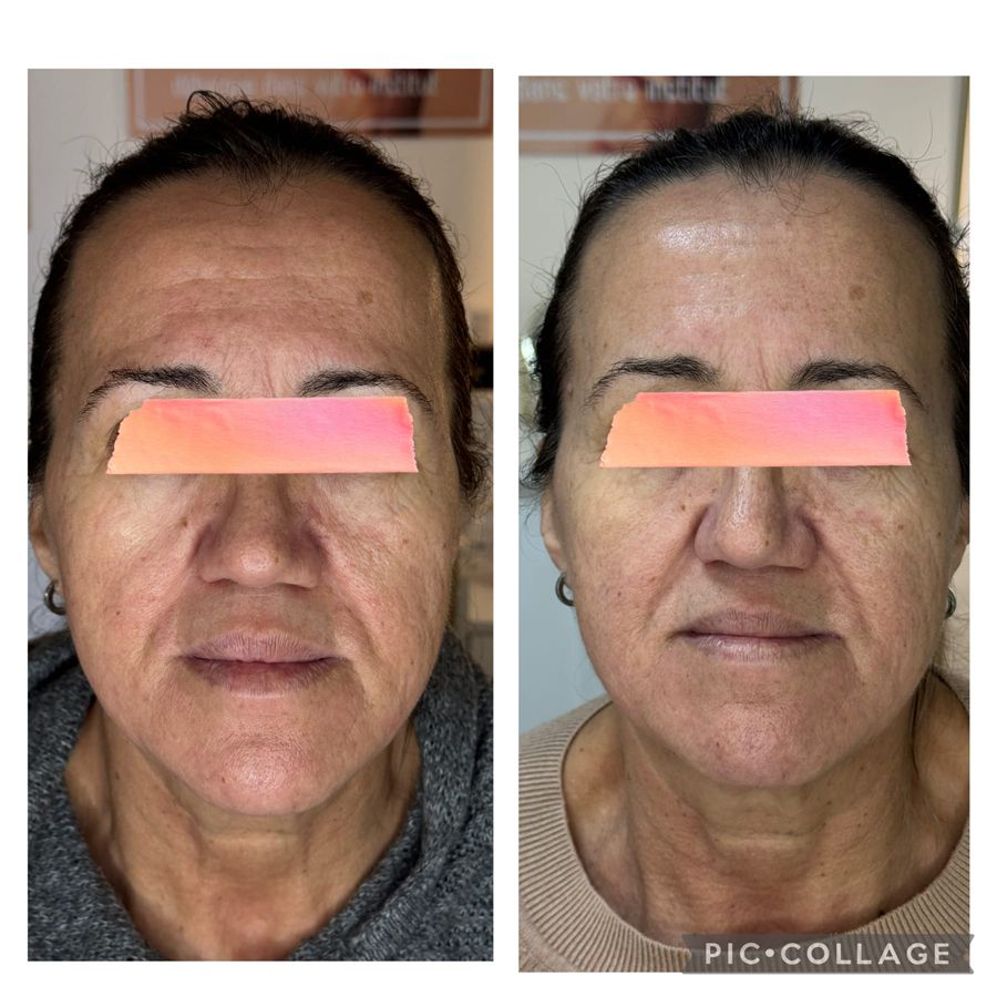 avant après : soin anti-âge avec Adipologie®