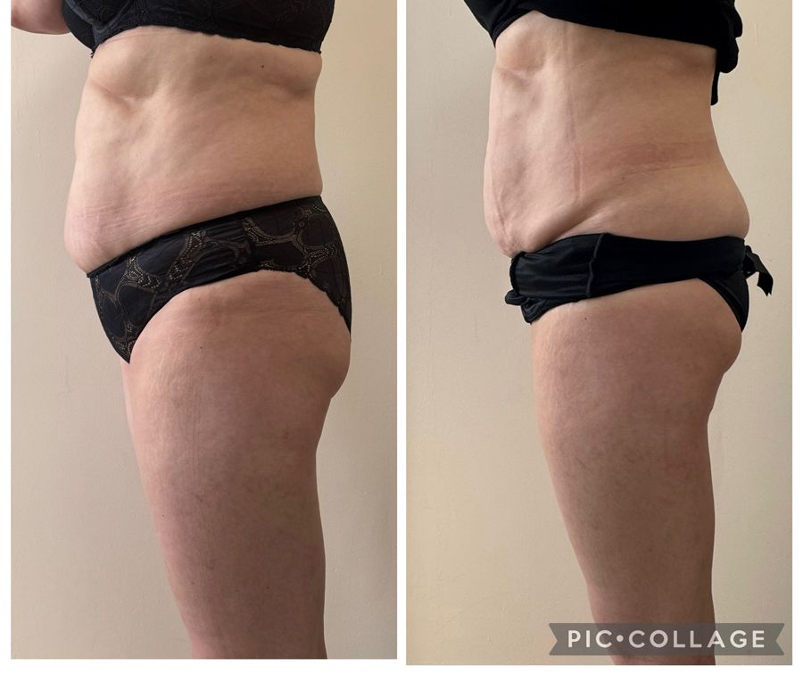 Avant après traitement minceur par Derma Studio