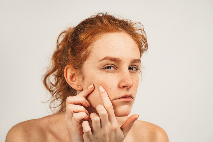 diagnostic d'une peau acnéique avec DP Skin
