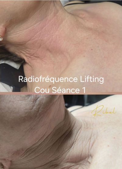 cou avant après lifting radiofréquence avec Genesis®