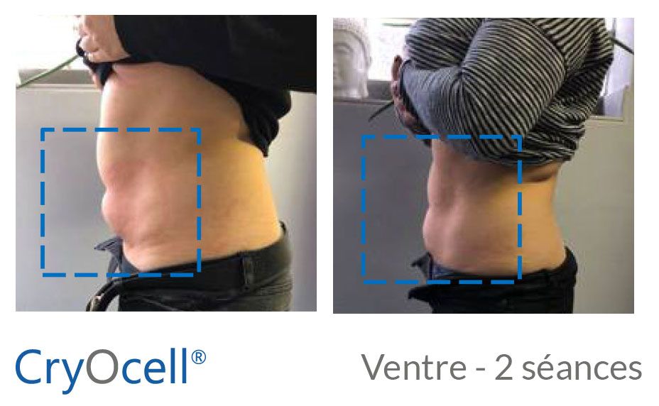 avant après cryolipolyse ventre 2 séances